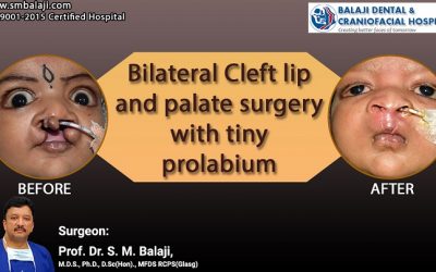 Bilateral Cleft Lip And Palate Surgery With Tiny Prolabium