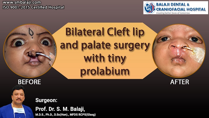 Bilateral Cleft Lip and Palate Surgery with Tiny Prolabium