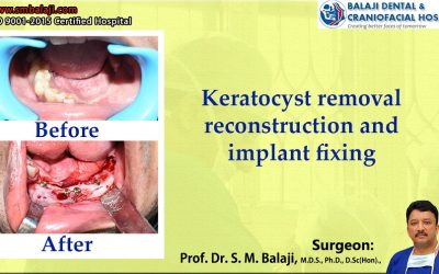 Keratocyst Removal, Reconstruction And Implant Fixing