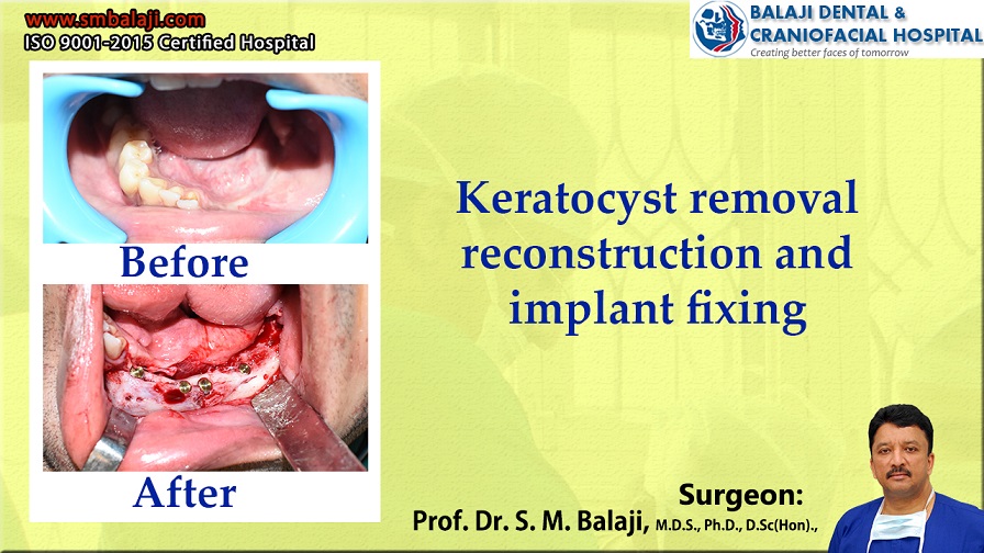 Keratocyst Removal, Reconstruction and Implant Fixing