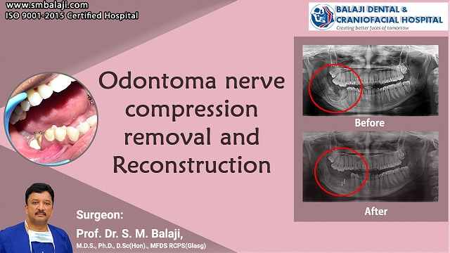 Odontoma Nerve Compression Removal and Reconstruction