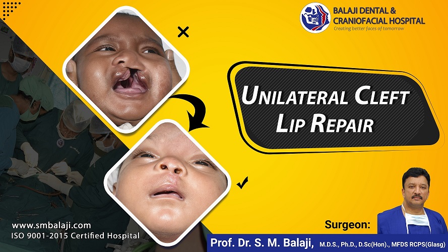 Unilateral Cleft lip repair