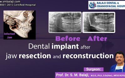 Dental Implant After Jaw Resection And Reconstruction