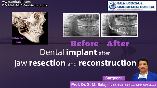 Dental Implant after Jaw Resection and Reconstruction