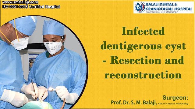 Infected dentigerous cyst – Resection and reconstruction