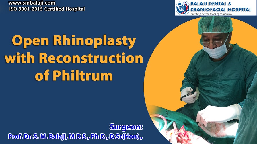 Open rhinoplasty with reconstruction of philtrum
