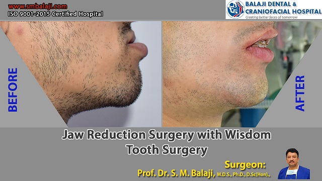 Jaw Reduction Surgery with Wisdom Tooth Surgery