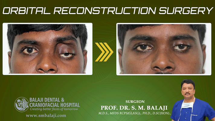 Orbital Reconstruction Surgery In India