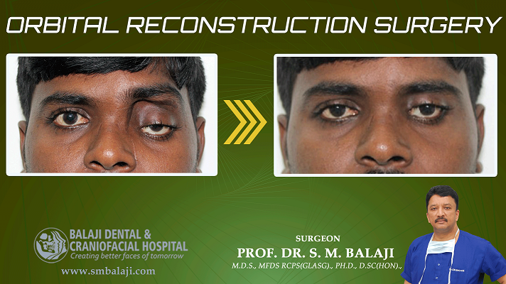 5 Heartwarming Stories of Orbital Reconstruction Surgery in India.