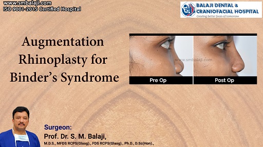 Augmentation Rhinoplasty For Binder’s Syndrome