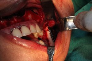 Stages of Distraction Osteogenesis 1 Osteotomy