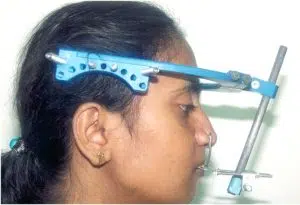 Distraction Osteogenesis 3 Distraction With Rigid External Distractor (Red)