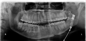 Stages of Distraction Osteogenesis 2 Latency Period