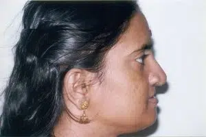 Distraction Osteogenesis 4 Upper Jaw Advancement And Improved Profile After Distraction