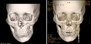 Stages of Distraction Osteogenesis 4 Consolidation Period
