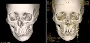 Consolidation Period