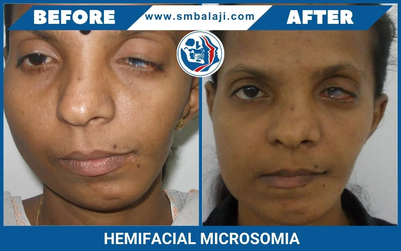 Hemifacial Microsomia Surgery