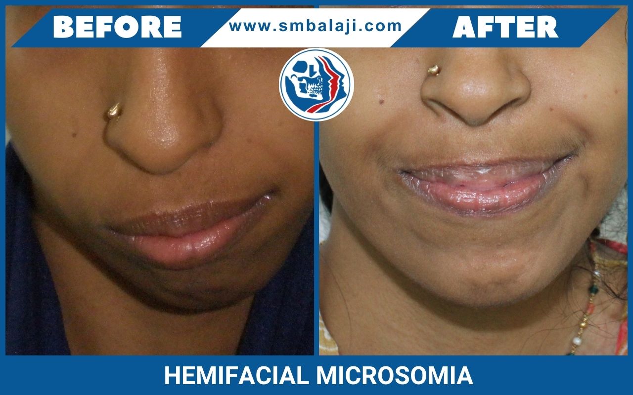 Hemifacial Microsomia