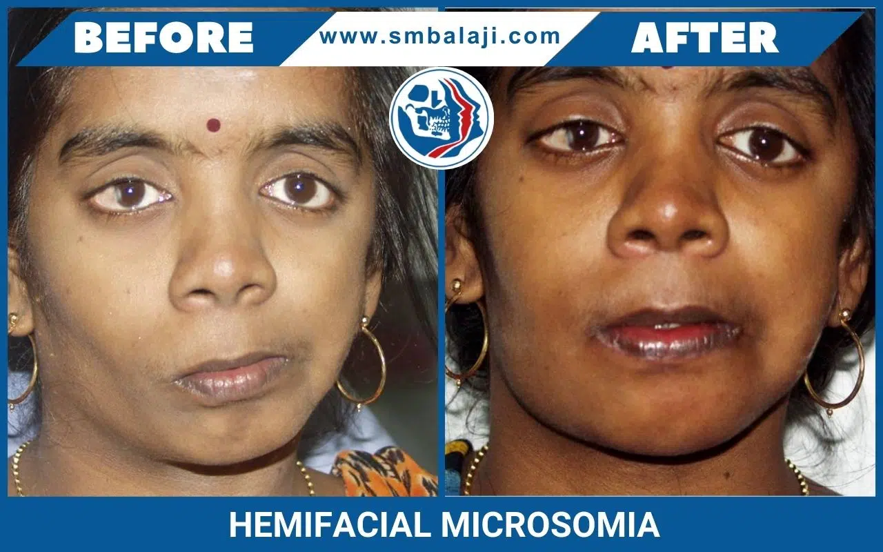 Hemifacial Microsomia