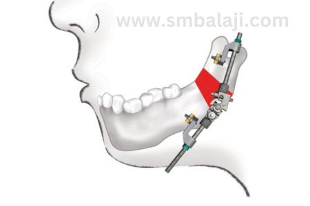 Types of Distraction Osteogenesis 8 Mandibular External Pin Retained Multivector Distractor Placed In Lower Jaw