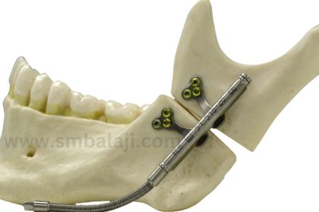 Types of Distraction Osteogenesis 6 Mandibular Univector Internal Distractor With Rigid And Flexible Activation Arms Fixed To Lower Jaw Bone.