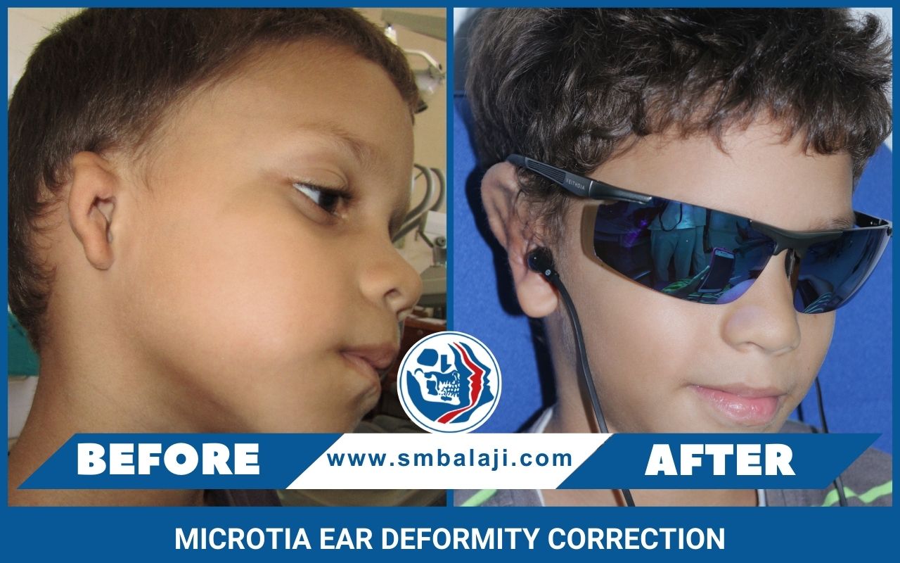 Microtia Ear Deformity Correction