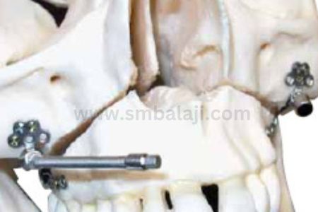 Types of Distraction Osteogenesis 4 Right And Left Maxillary Internal Distractors With Flexible Activation Arms Placed Inside The Mouth.
