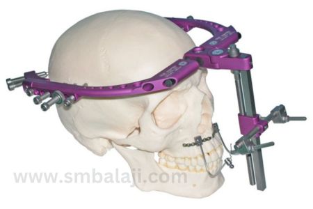 Types of Distraction Osteogenesis 2 Rigid External Distractor (Red) Fixed To The Skull Bones.