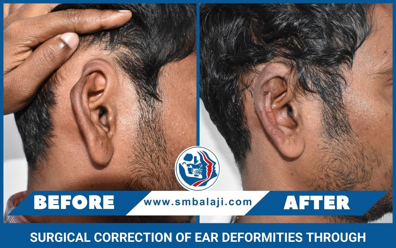 Surgical Correction Of Ear Deformities Through Otoplasty