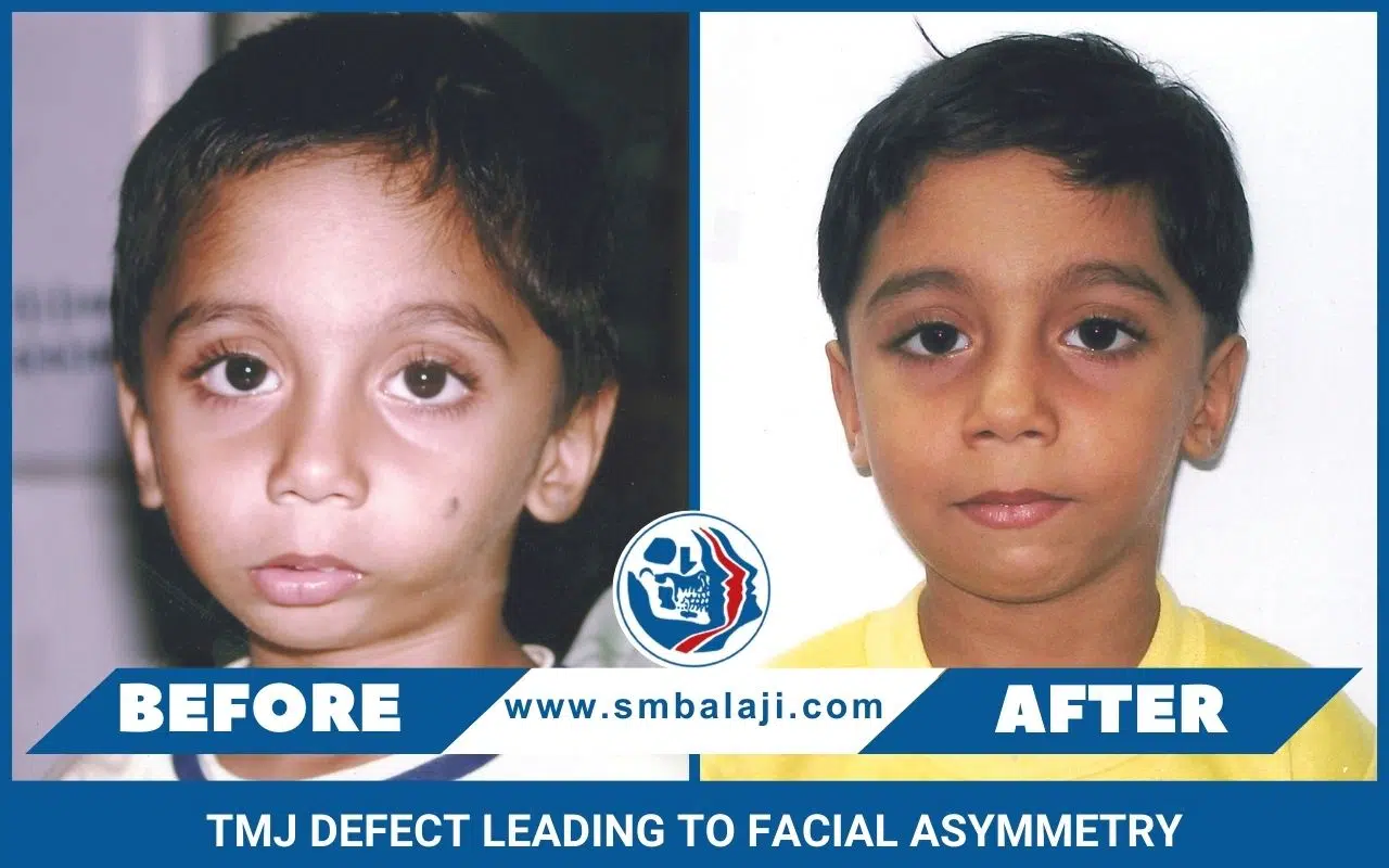 TMJ defect leading to facial asymmetry