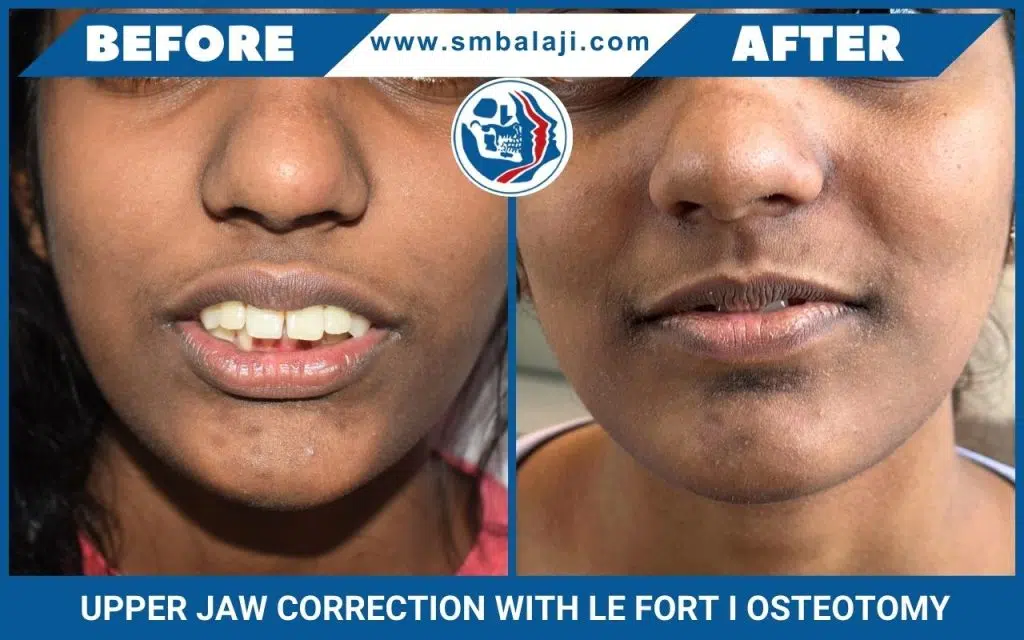 Upper Jaw Correction with Le Fort I Osteotomy 4 Upper Jaw Correction With Le Fort I Osteotomy