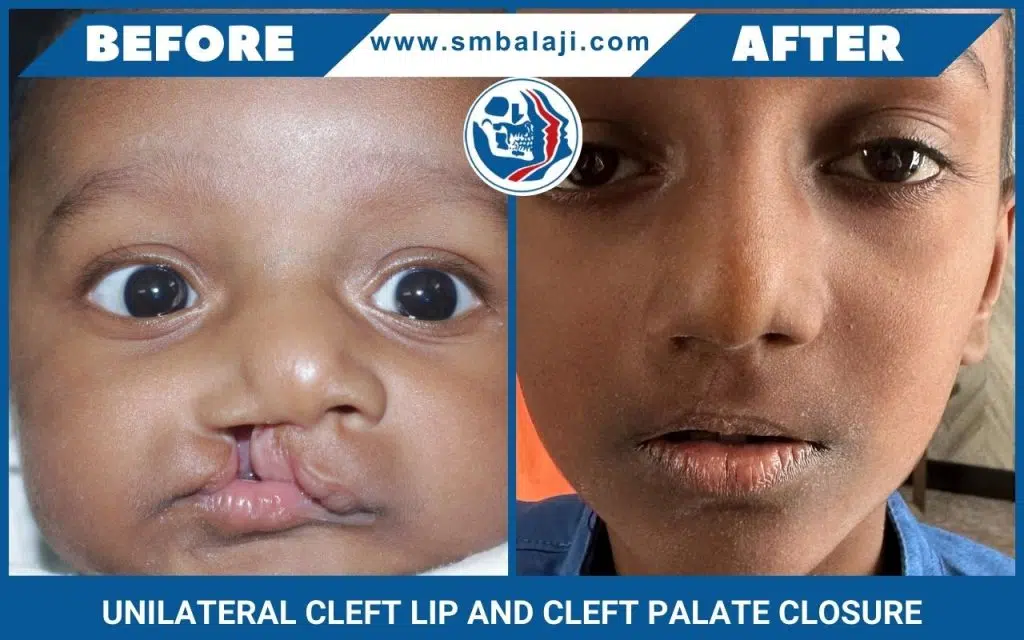 Reversing the Smile: Transforming Lives Through Unilateral Cleft Lip and Palate Closure at Dr. S.M. Balaji 16 Unilateral Cleft Lip And Cleft Palate Closure