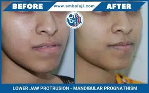 Mandibular Prognathism