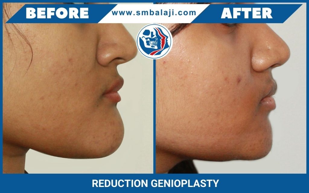 Genioplasty 1 Reduction Denioplasty