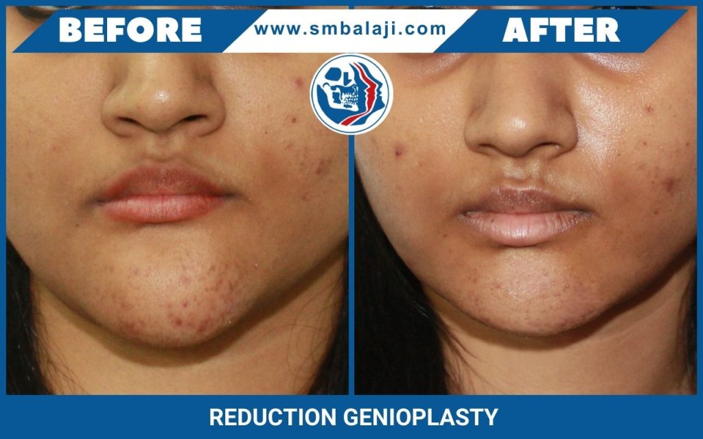 Genioplasty 2 Reduction Denioplasty