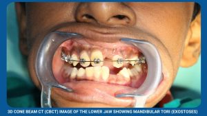 3D Cone Beam Ct (Cbct) Image Of The Lower Jaw Showing Mandibular Tori (Exostoses)