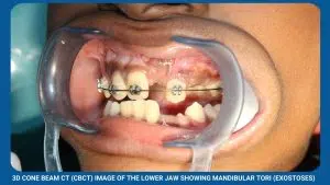 Exposure of Unerupted Teeth 1 3D Cone Beam Ct (Cbct) Image Of The Lower Jaw Showing Mandibular Tori (Exostoses) (2)