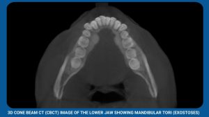 3D Cone Beam Ct (Cbct) Image Of The Lower Jaw Showing Mandibular Tori (Exostoses) (2)
