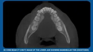 Pre-Prosthetic Surgery 1 3D Cone Beam Ct (Cbct) Image Of The Lower Jaw Showing Mandibular Tori (Exostoses) (2)