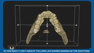 Pre-Prosthetic Surgery 2 3D Cone Beam Ct (Cbct) Image Of The Lower Jaw Showing Mandibular Tori (Exostoses)