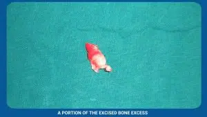Pre-Prosthetic Surgery 6 A Portion Of The Excised Bone Excess