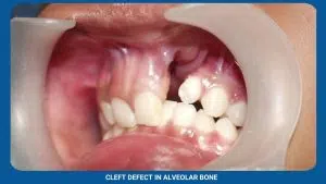 Bone Morphogenetic Protein 2 Cleft Defect In Alveolar Bone