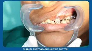 Exposure of Unerupted Teeth 3 Clinical Photograph Showing The Tori
