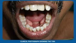 Pre-Prosthetic Surgery 3 Clinical Photograph Showing The Tori