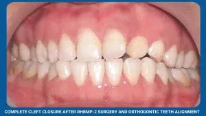 Bone Morphogenetic Protein 4 Complete Cleft Closure After Rhbmp-2 Surgery And Orthodontic Teeth Alignment