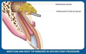 Infection And Root Tip Removed In Apicoectomy Procedure