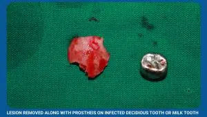 Lesion Removed Along With Prostheis On Infected Decidious Tooth Or Milk Tooth