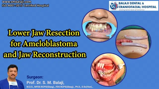 A Triumph Over Adversity: Jaw Reconstruction for Ameloblastoma - A Patient's Journey 26 Lower Jaw Resection For Ameloblastoma And Jaw Reconstruction