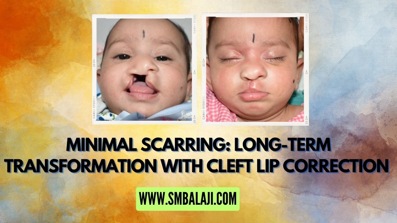 Long-Term Transformation with Cleft Lip Correction in India