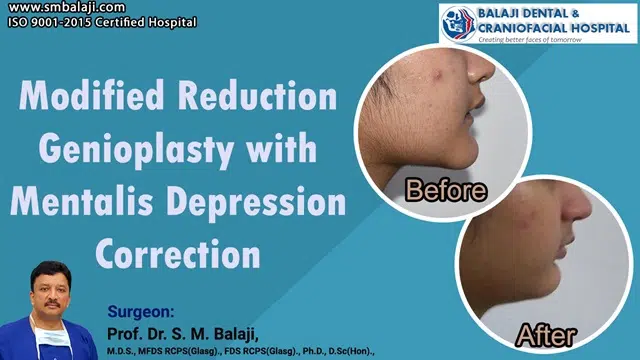 Modified Reduction Genioplasty With Mentalis Depression Correction